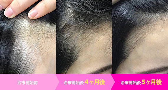 ヘアフィラーモニター体験談 女性の治療例