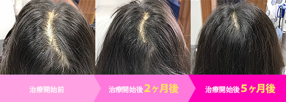 ヘアフィラーモニター体験談 女性の治療例